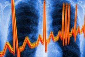 arythmie cardiaque pour l'ostéochondrose