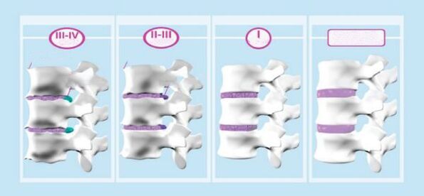 Étapes de l'ostéochondose cervicale