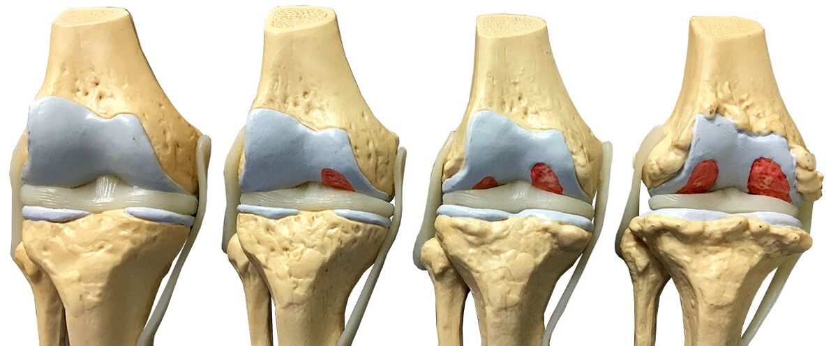 Étapes de l'arthrose